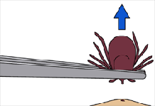 tick removal